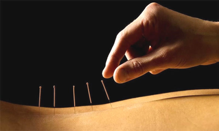 Acupuncture